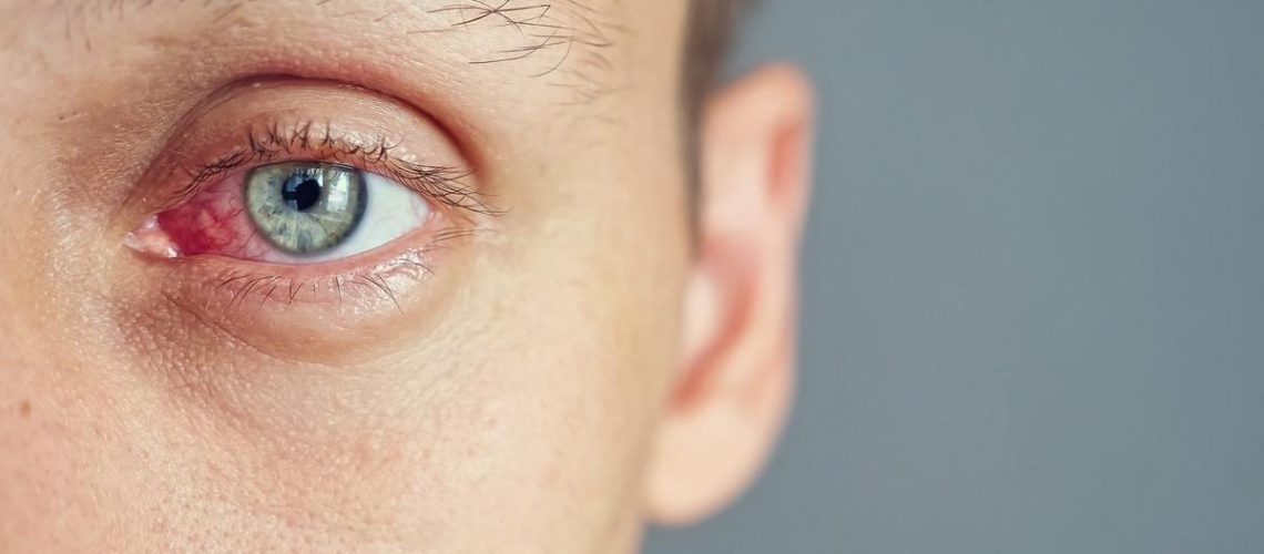 دکتر زخم قرنیه