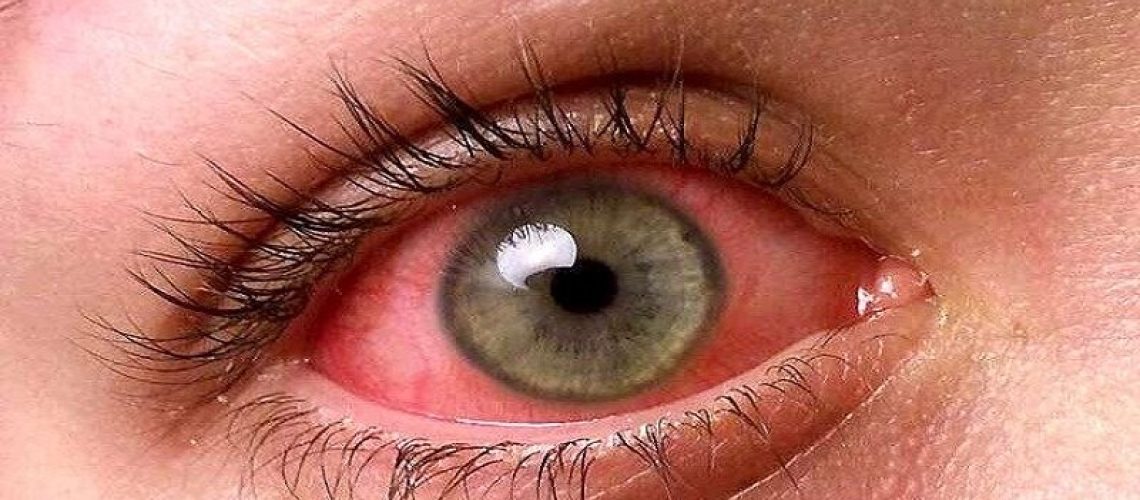 دکتر قرمزی چشم