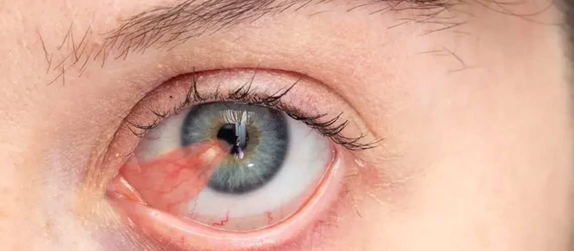 دکتر ناخنک چشم