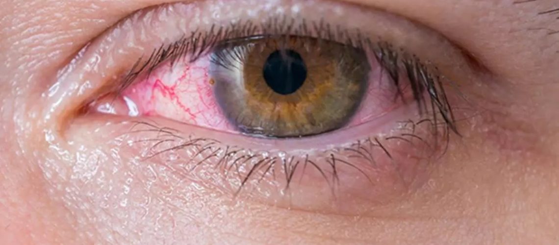 دکتر ورم ملتحمه یا چشم صورتی